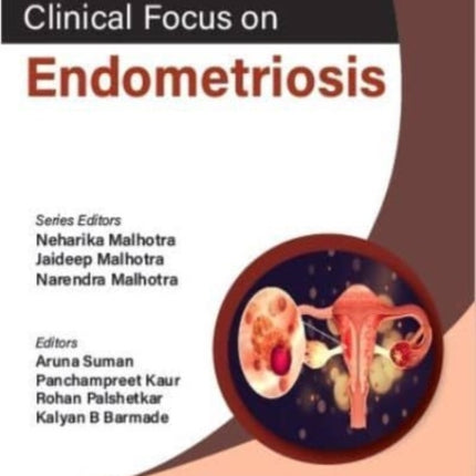 Clinical Focus on Endometriosis