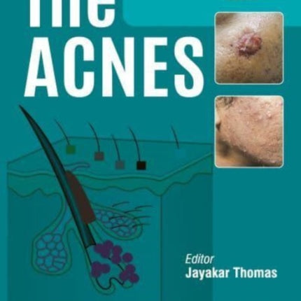 The Acnes