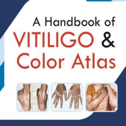 A Handbook of Vitiligo & Color Atlas