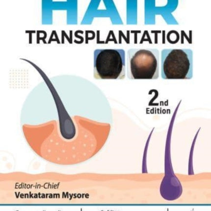 Hair Transplantation