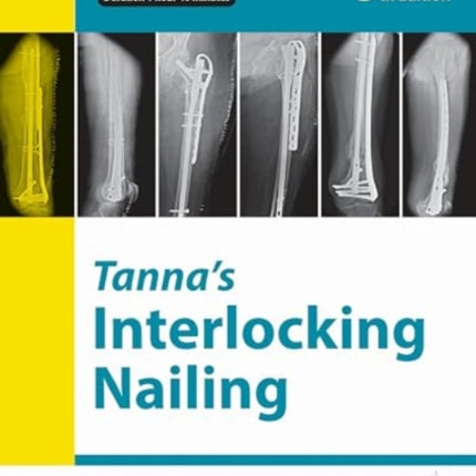 Tannas Interlocking Nailing