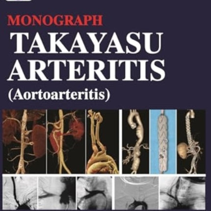 Takayasu Arteritis (Aortoarteritis)