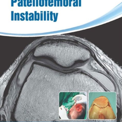 Patellofemoral Instability