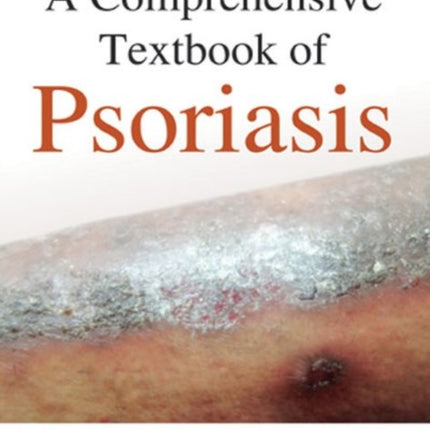 A Comprehensive Textbook of Psoriasis