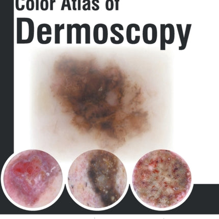 Color Atlas of Dermoscopy