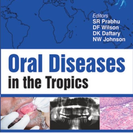 Oral Diseases in the Tropics