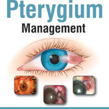 Textbook of Pterygium Management