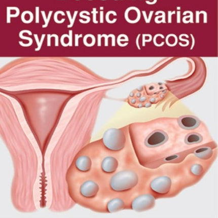 Decoding Polycystic Ovarian Syndrome