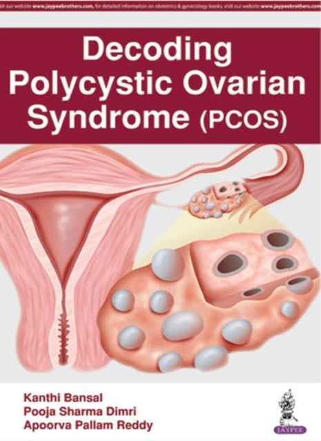 Decoding Polycystic Ovarian Syndrome