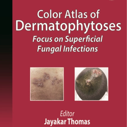Color Atlas of Dermatophytoses: Focus on