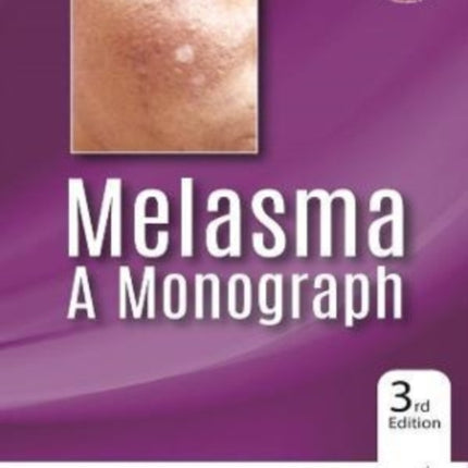 Melasma: A Monograph