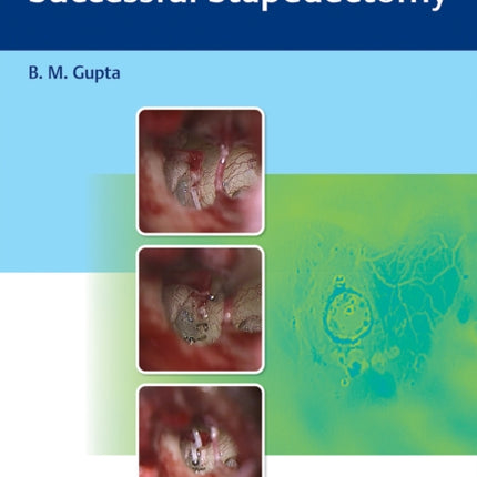 An Approach to Successful Stapedectomy