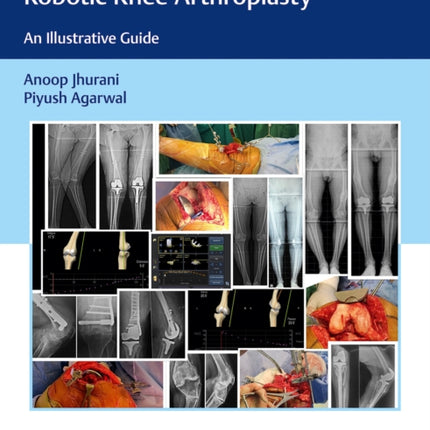 Computer Navigated and Handheld Robotic Knee Arthroplasty: An Illustrative Guide