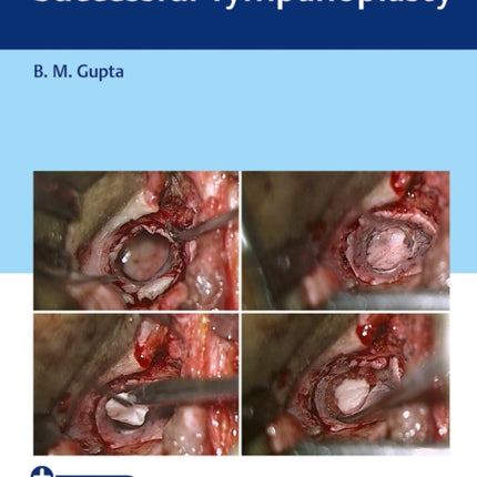 An Approach to Successful Tympanoplasty