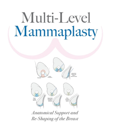 Multi-level Mammaplasty: Anatomical Support And