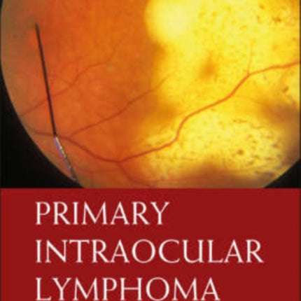 Primary Intraocular Lymphoma