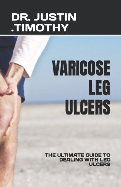Varicose Leg Ulcers: The Ultimate Guide to